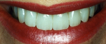 Cosmetic dentistry by an artistic cosmetic dentist